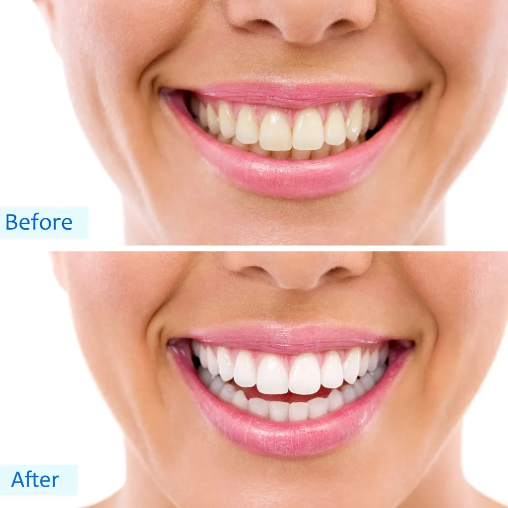 teeth whitening chesterfield